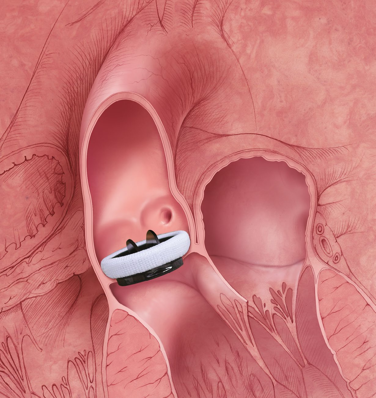 Carbomedics Standard Pediatric — 16 & 18 mm aortic valve in situ