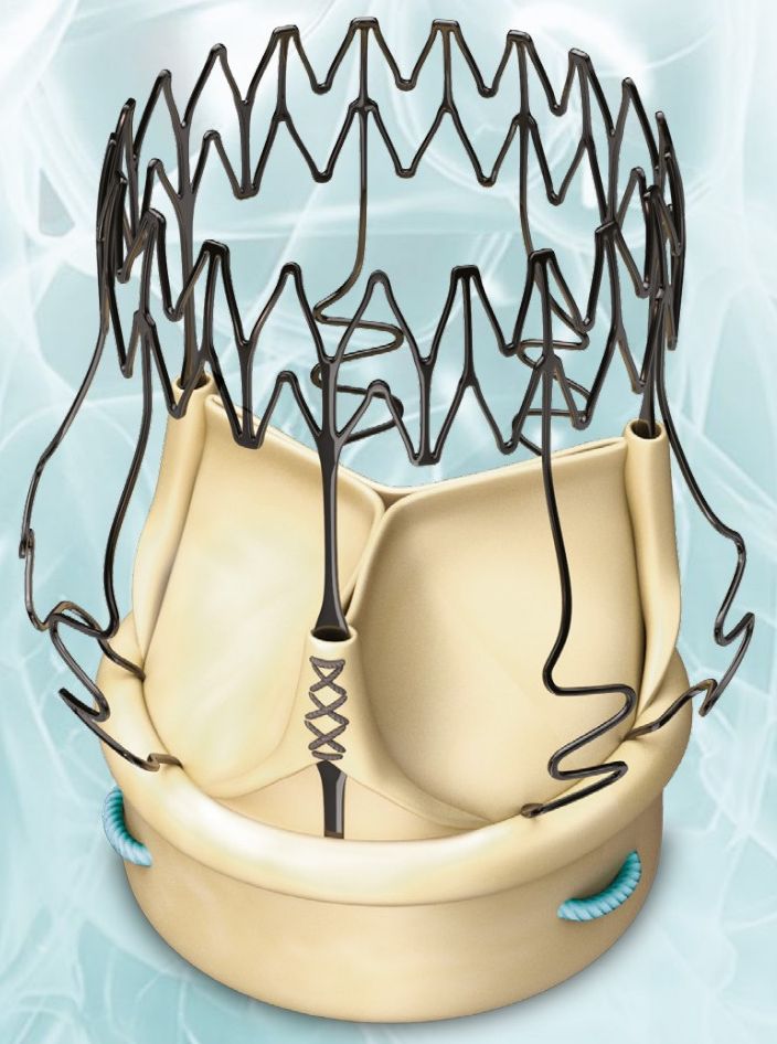Corcym — Perceval & Carbomedics — Heart valves — sutureless, biological & mechanical