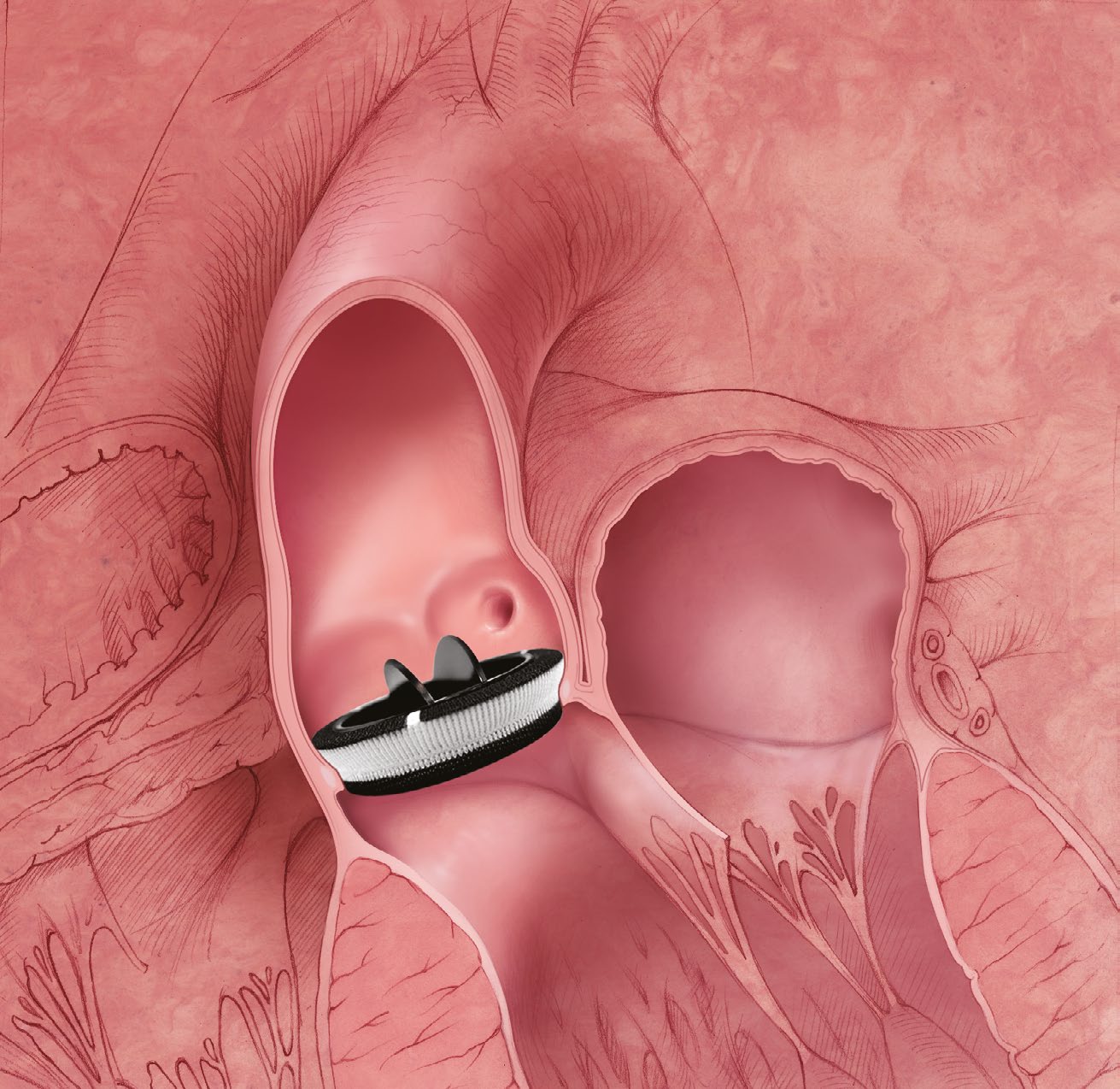 Carbomedics Top Hat — totally supra-annular aortic placement