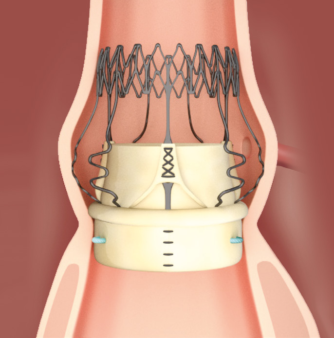 Perceval implanted in the aortic annulus — self-anchoring, no permanent sutures